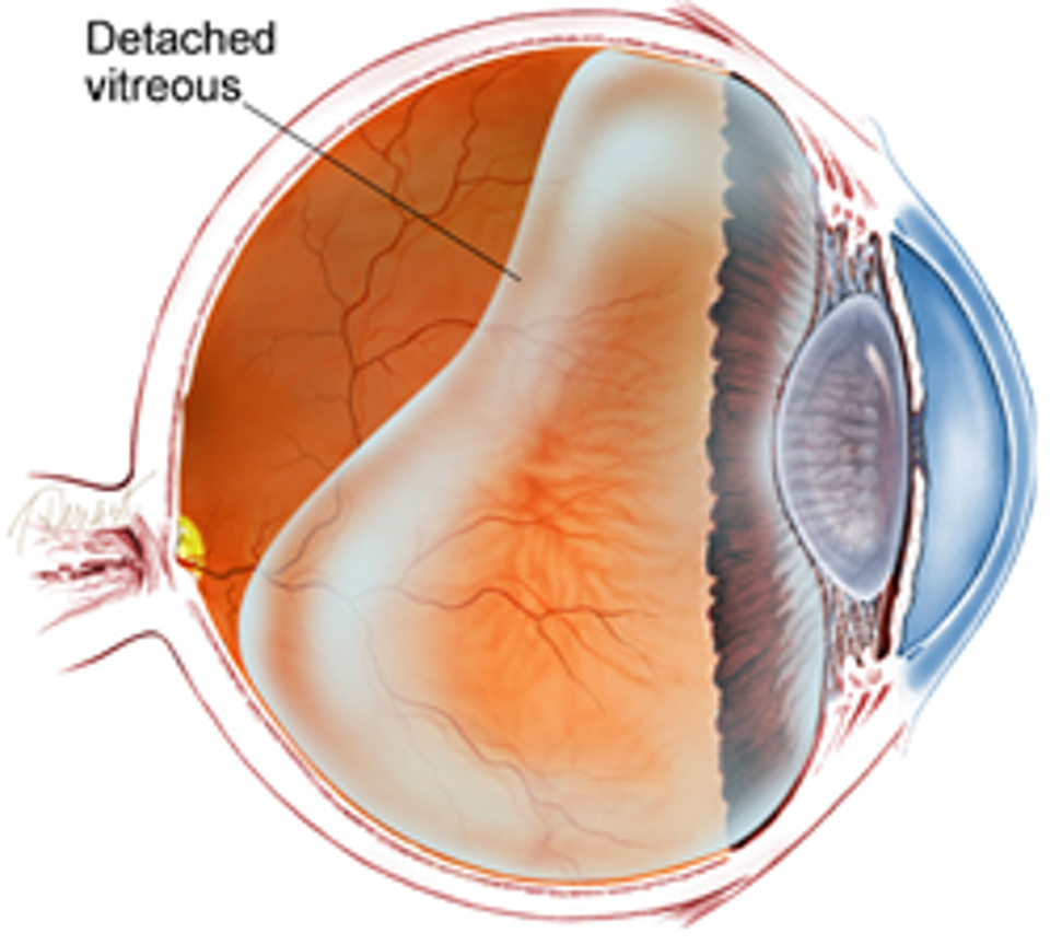 What You Need To Know About Posterior Vitreous Detachment PVD What You Need To Know About Posterior Vitreous Detachment PVD