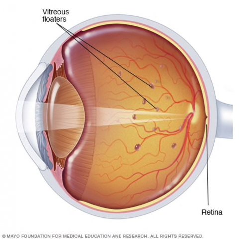 Eye Floaters vitreous