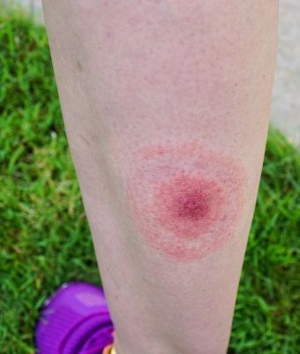 Lyme disease Feature