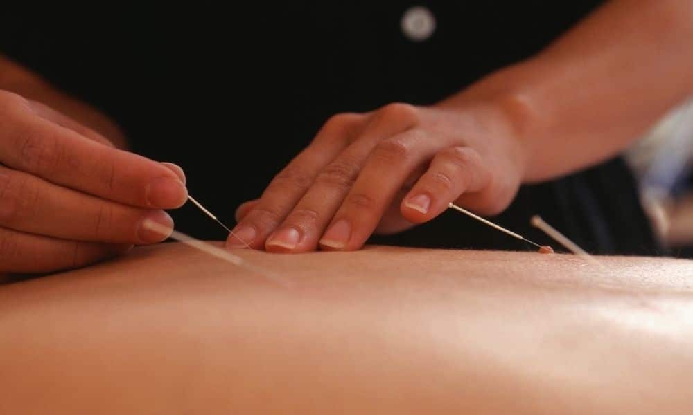 Acupuncture